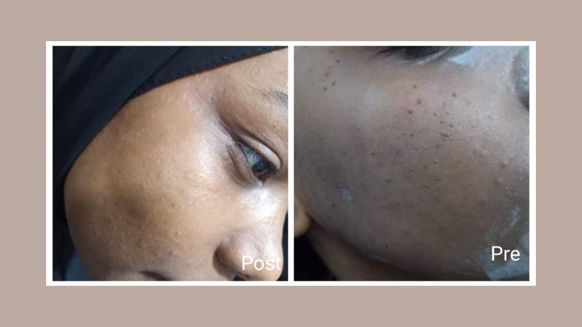 فراكشنال ليزر في الغردقة